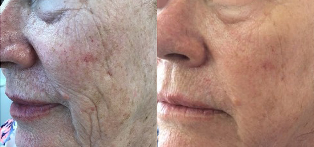 microneedling in encino