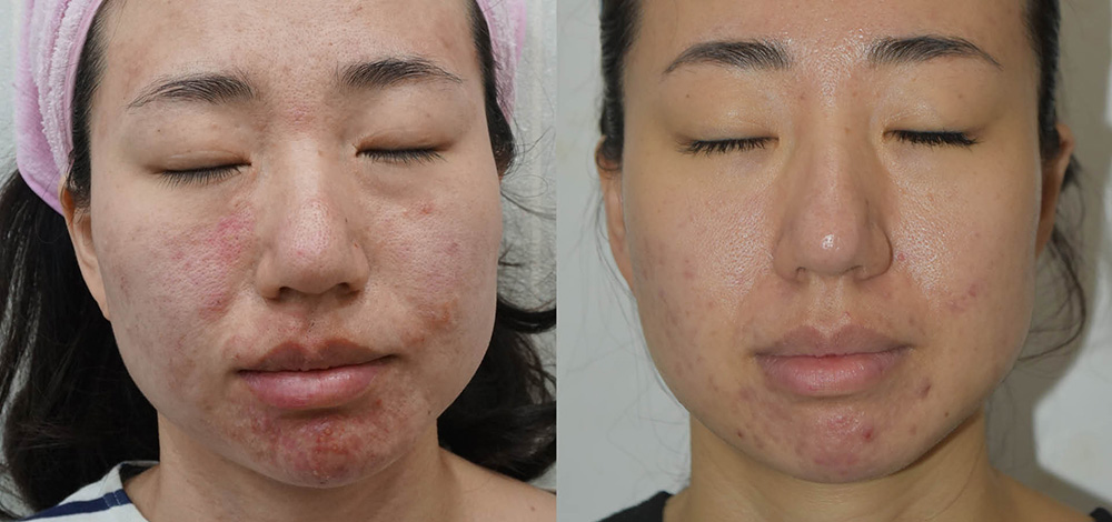 microneedling in encino